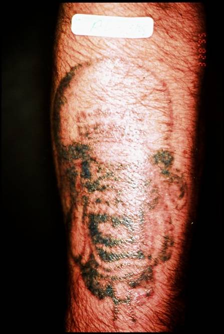 Laser Tattoo Removal