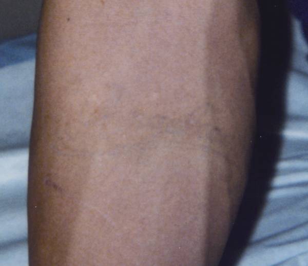 Tattoo Removal Eight Treatments | Male Models Picture