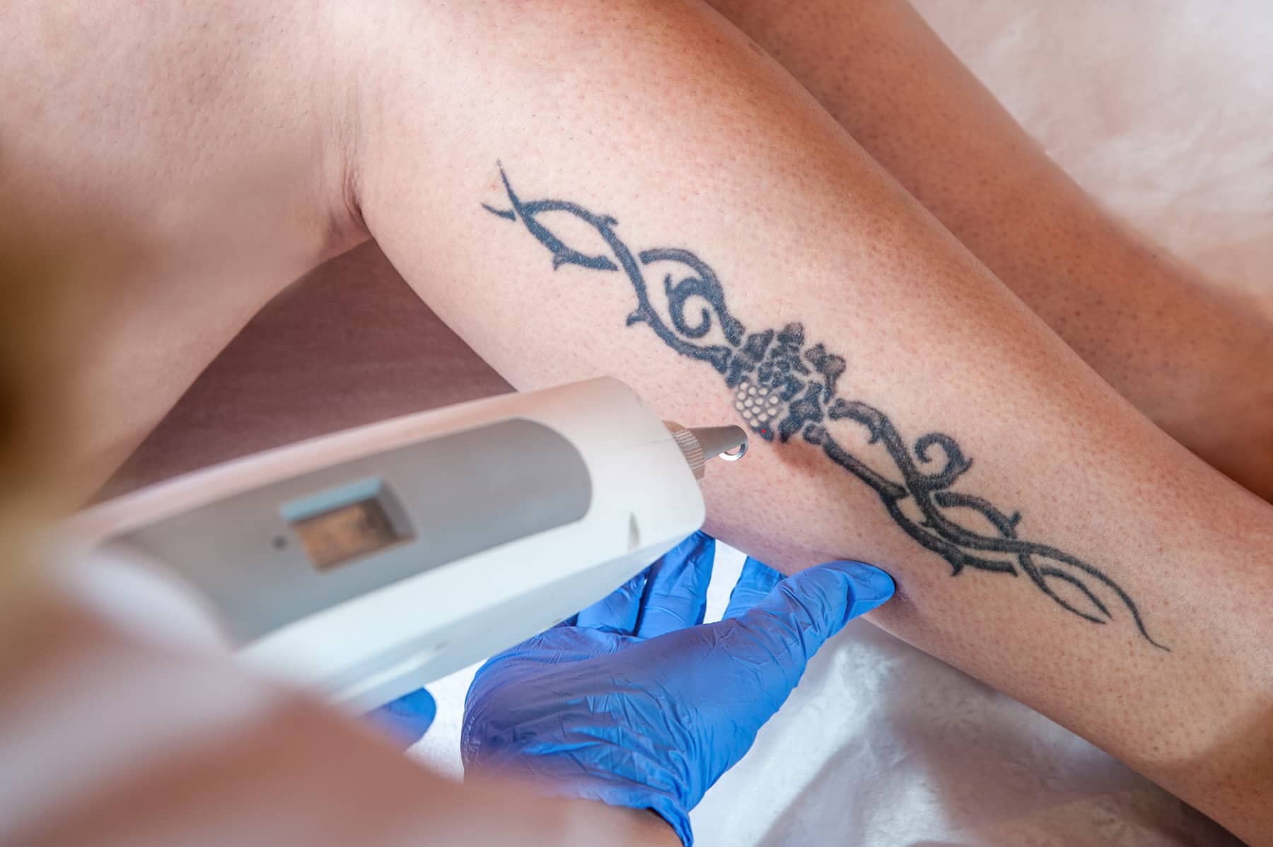Tampa Bay Laser Tattoo Removal